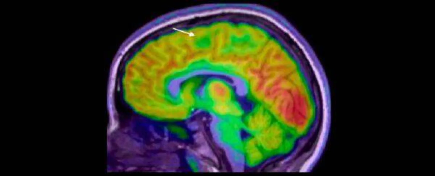 الذكاء الاصطناعي يساعد في تشخيص «الصرع»