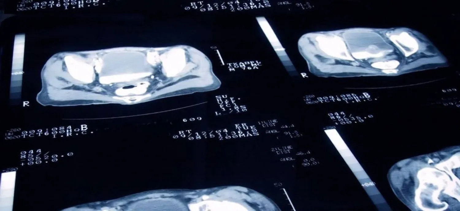 أكثر من مليوني رجل يراجعون الطبيب سنوياً بسبب أعراض التهاب البروستاتا (بكسباي)