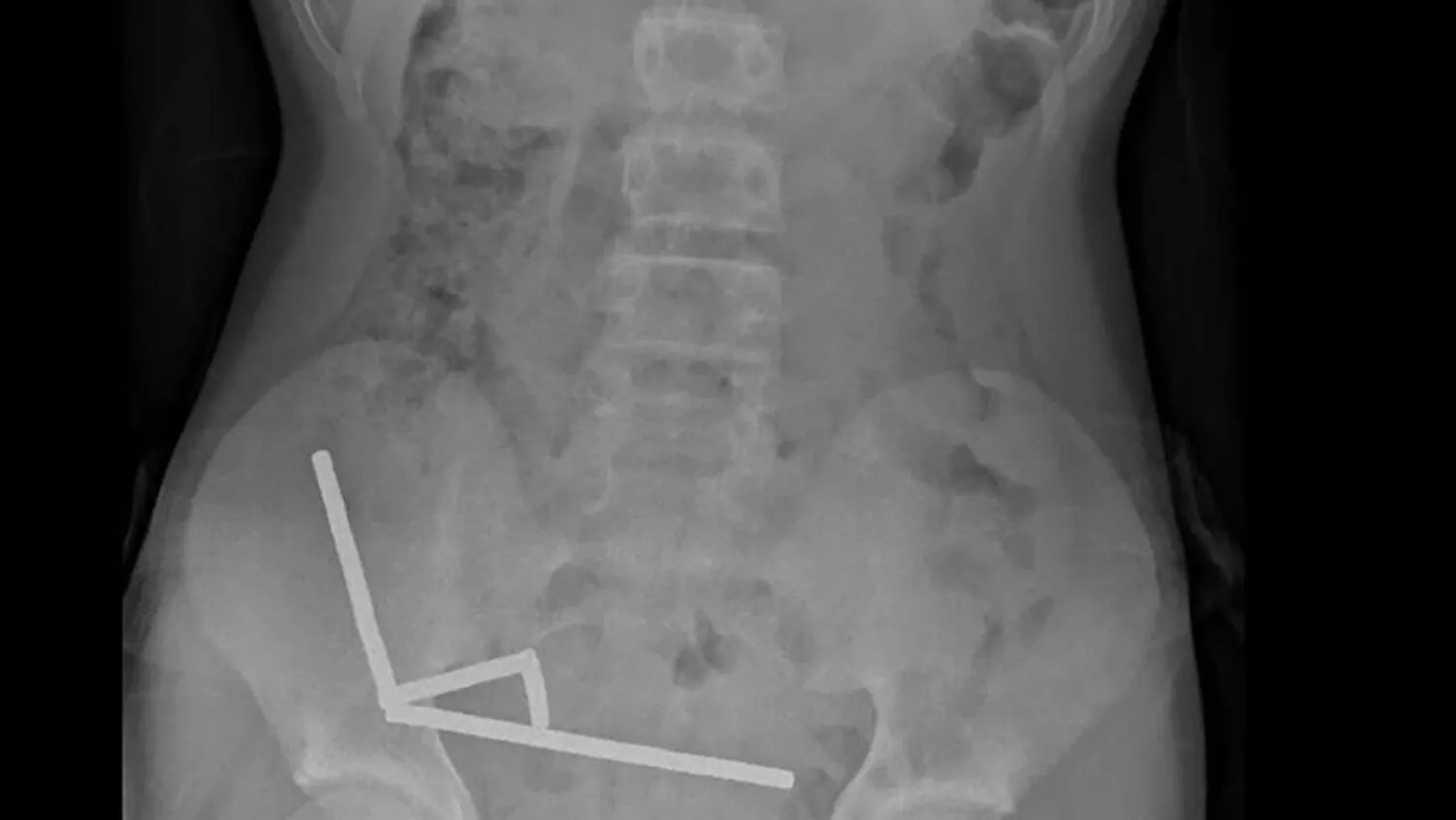 This undated handout released on October 24, 2025 from the New Zealand Medical Journal (NZMJ) shows an x-ray image of pieces of high-power magnets clumped up in the intestines of a New Zealand teenager in Tauranga. Handout / NEW ZEALAND MEDICAL JOURNAL (NZMDJ)/AFP
