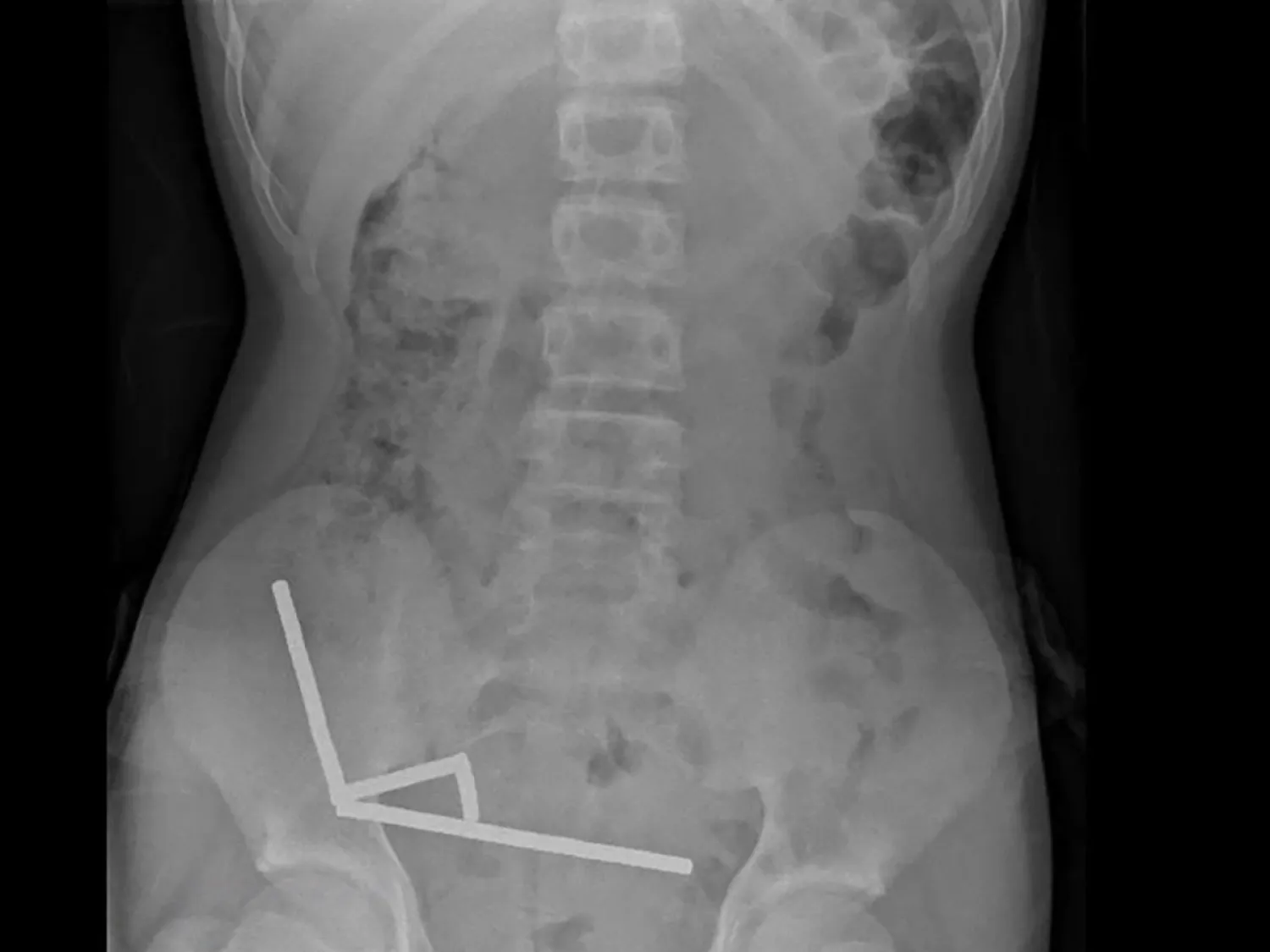 صورة أشعة سينية لقطع المغناطيس متكتلة في أمعاء المراهق النيوزيلندي (أ.ف.ب)