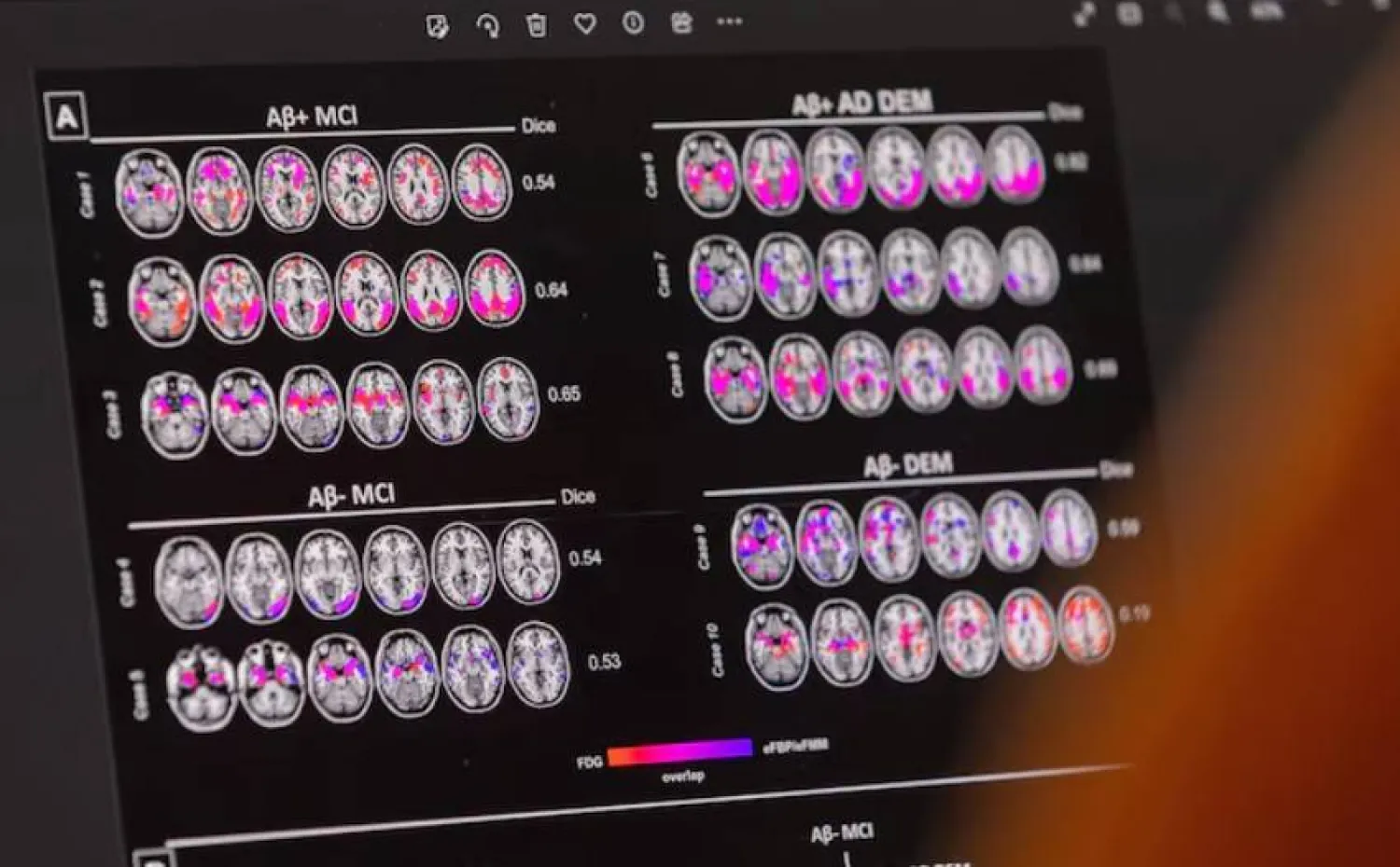 الخرف هو مجموعة من الاضطرابات الإدراكية التي تؤدي إلى تراجع في الذاكرة والتفكير والقدرات الذهنية الأخرى (أرشيفية - رويترز)