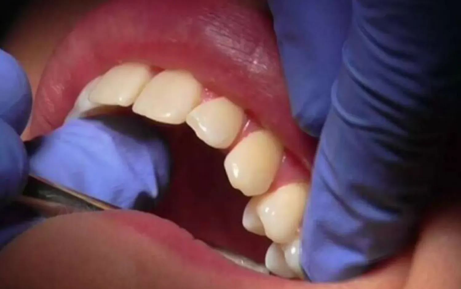 علاج قناة الجذر يُمكن أن تكون له فوائد صحية على الجسم بأكمله (رويترز)