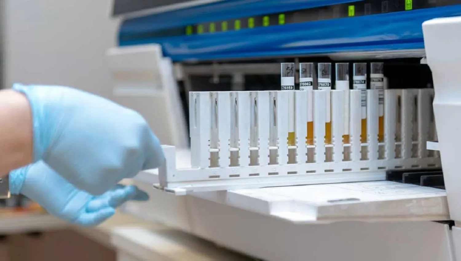 الفحص الجديد يعتمد على عينة بول لتشخيص سرطان المثانة بدقة (مركز موفيت للسرطان في أميركا)