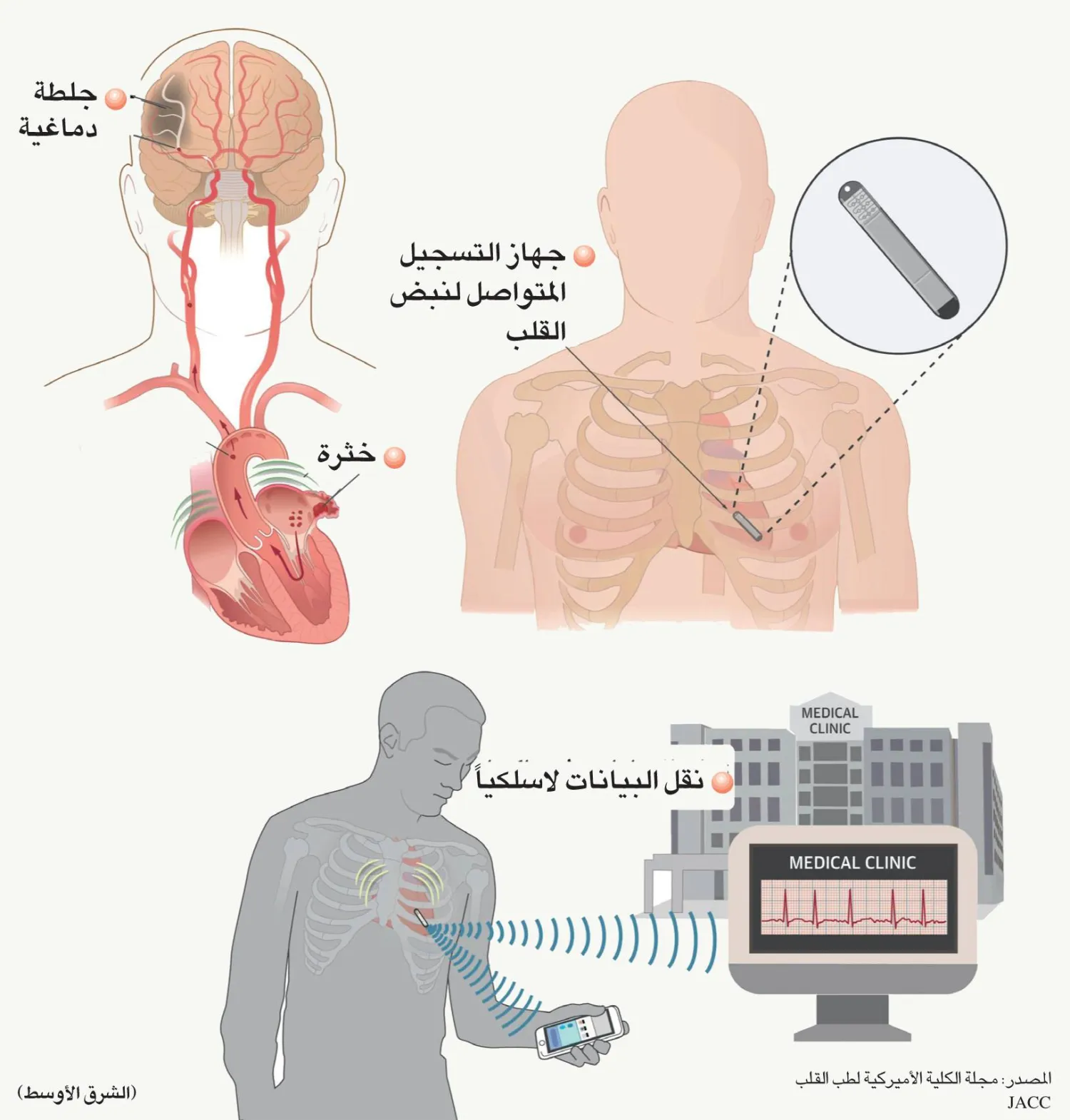 استشارات: مُسجِّل مزروع لرصد نبضات القلب - إزعاج غازات البطن