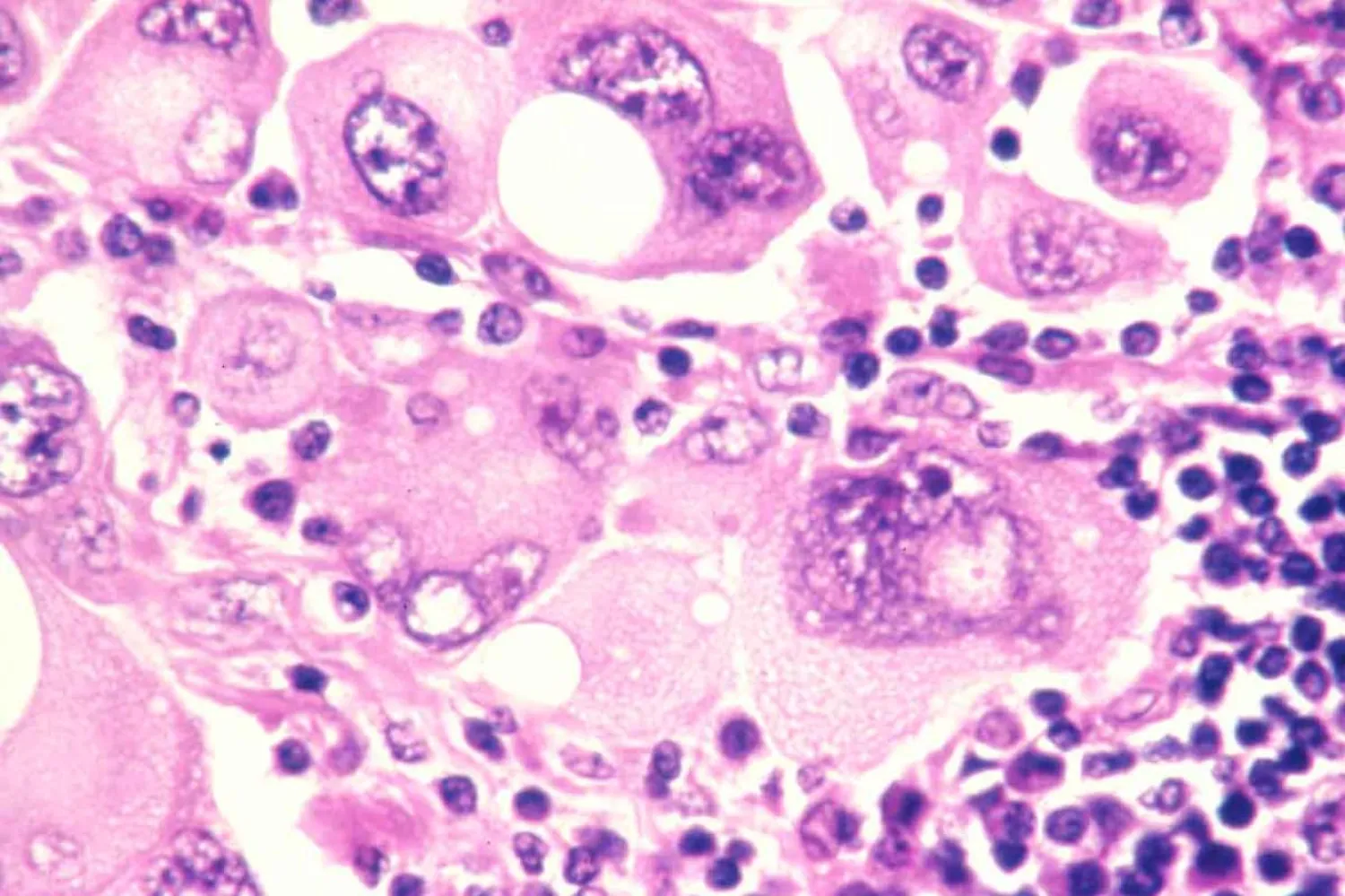 Amerika kıtasındaki araştırmacılar, melanom tümörlerini daha iyi tedavi etmelerini sağlayabilecek anahtar bir protein keşfetti (ABD Ulusal Kanser Enstitüsü)