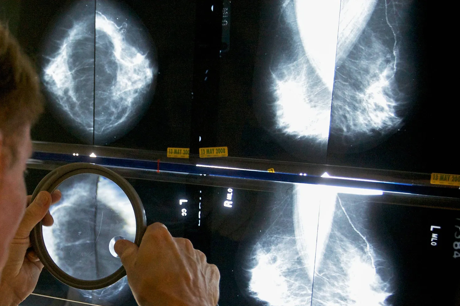 FILE - A radiologist uses a magnifying glass to check mammograms for breast cancer in Los Angeles, May 6, 2010. (AP Photo/Damian Dovarganes, File)