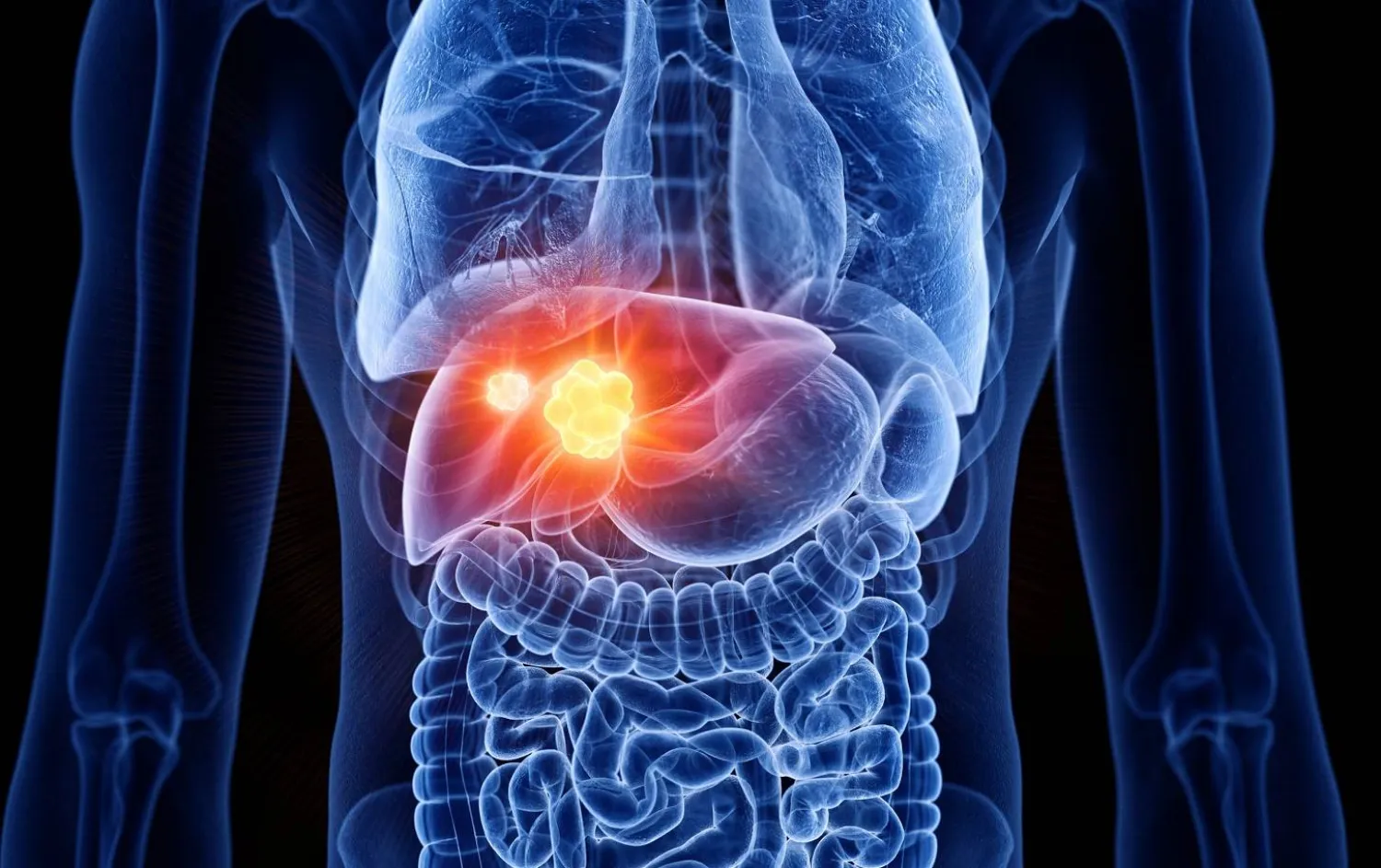 سرطان الكبد من أكثر أنواع السرطان خطورة وانتشاراً في العالم (جامعة فلوريدا)