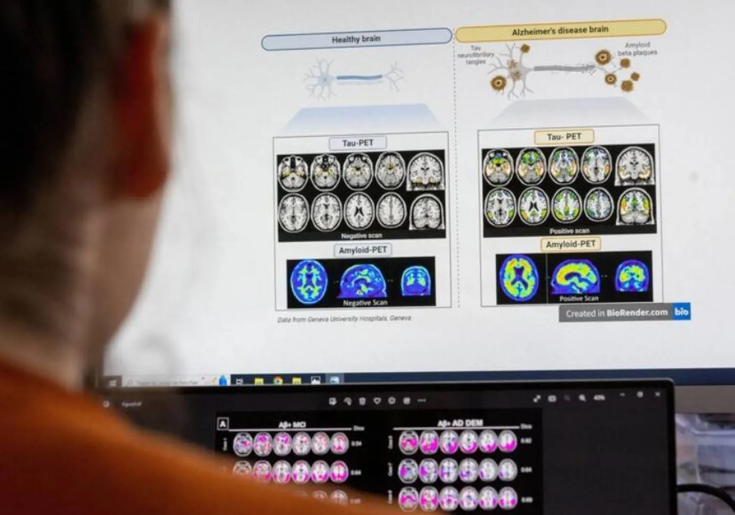 اختبار بسيط قد يتنبأ بأعراض «ألزهايمر» قبل سنوات