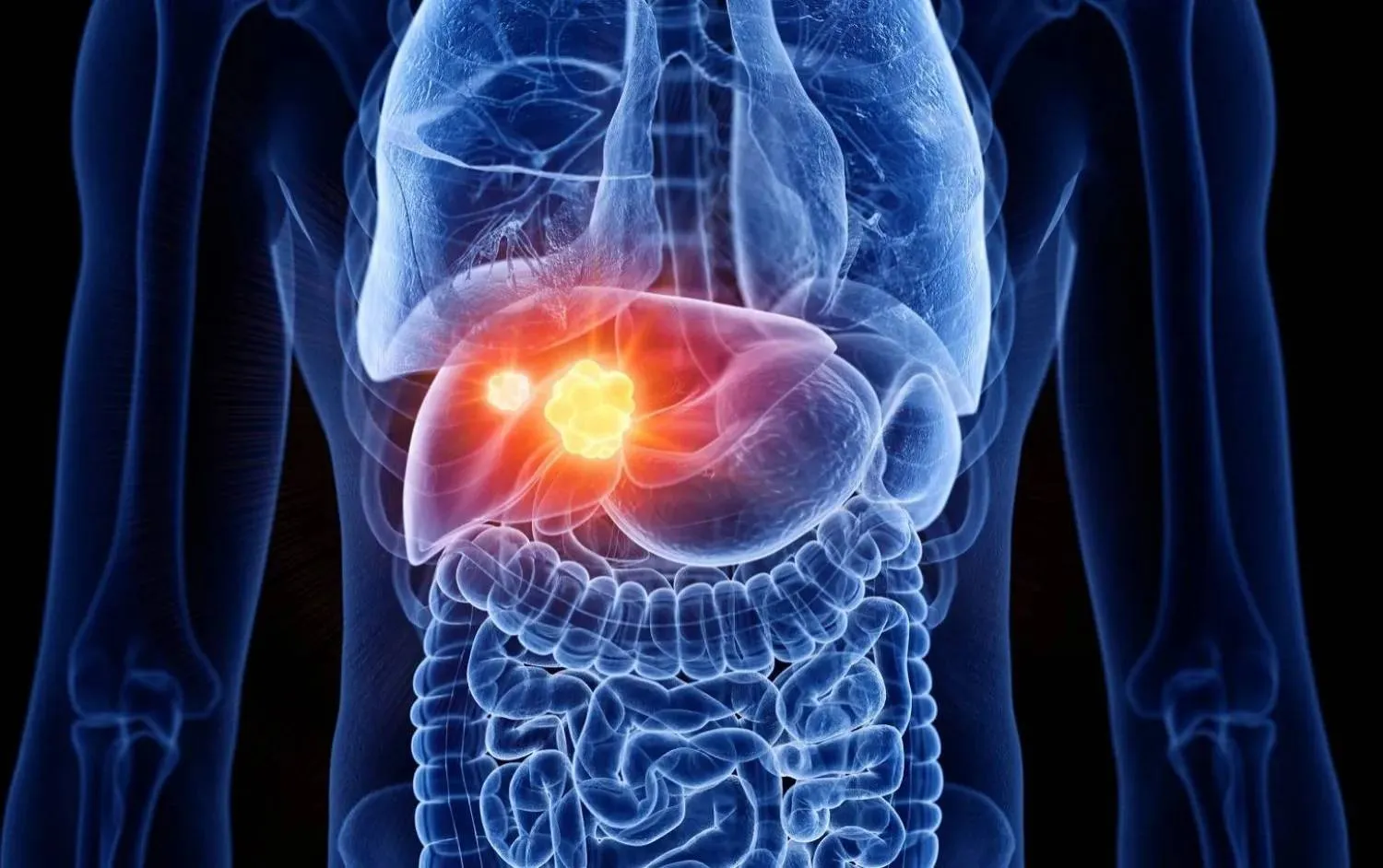سرطان الكبد من أكثر أنواع السرطان خطورة وانتشاراً في العالم (جامعة فلوريدا)