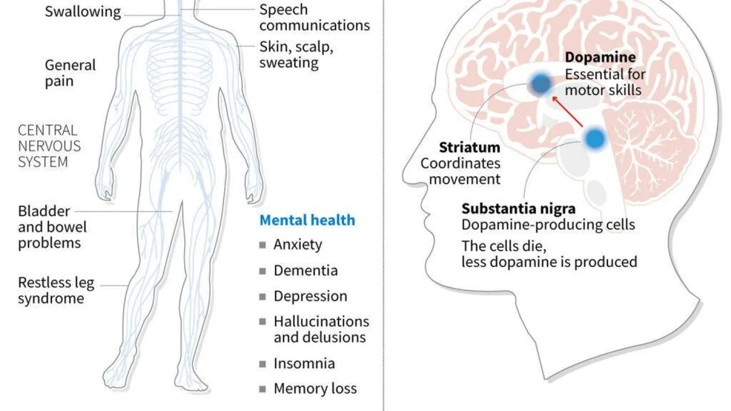 Parkinson's disease. John SAEKI, Adrian LEUNG / AFP
