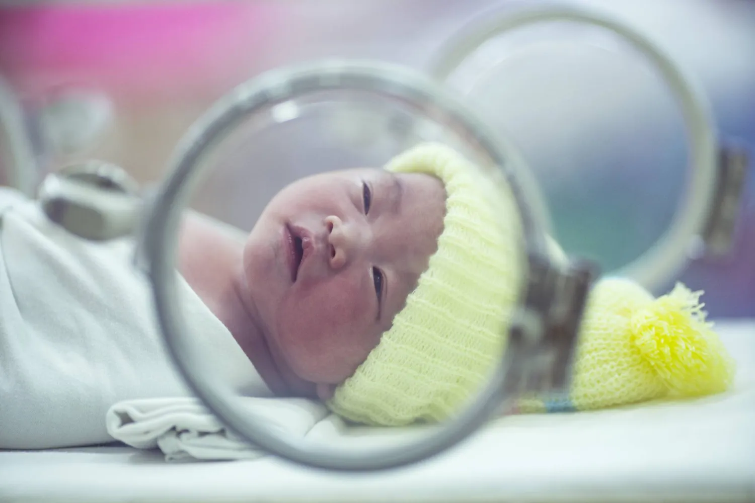 قطرة الكورتيزون تنقذ بصر الأطفال الخُدّج