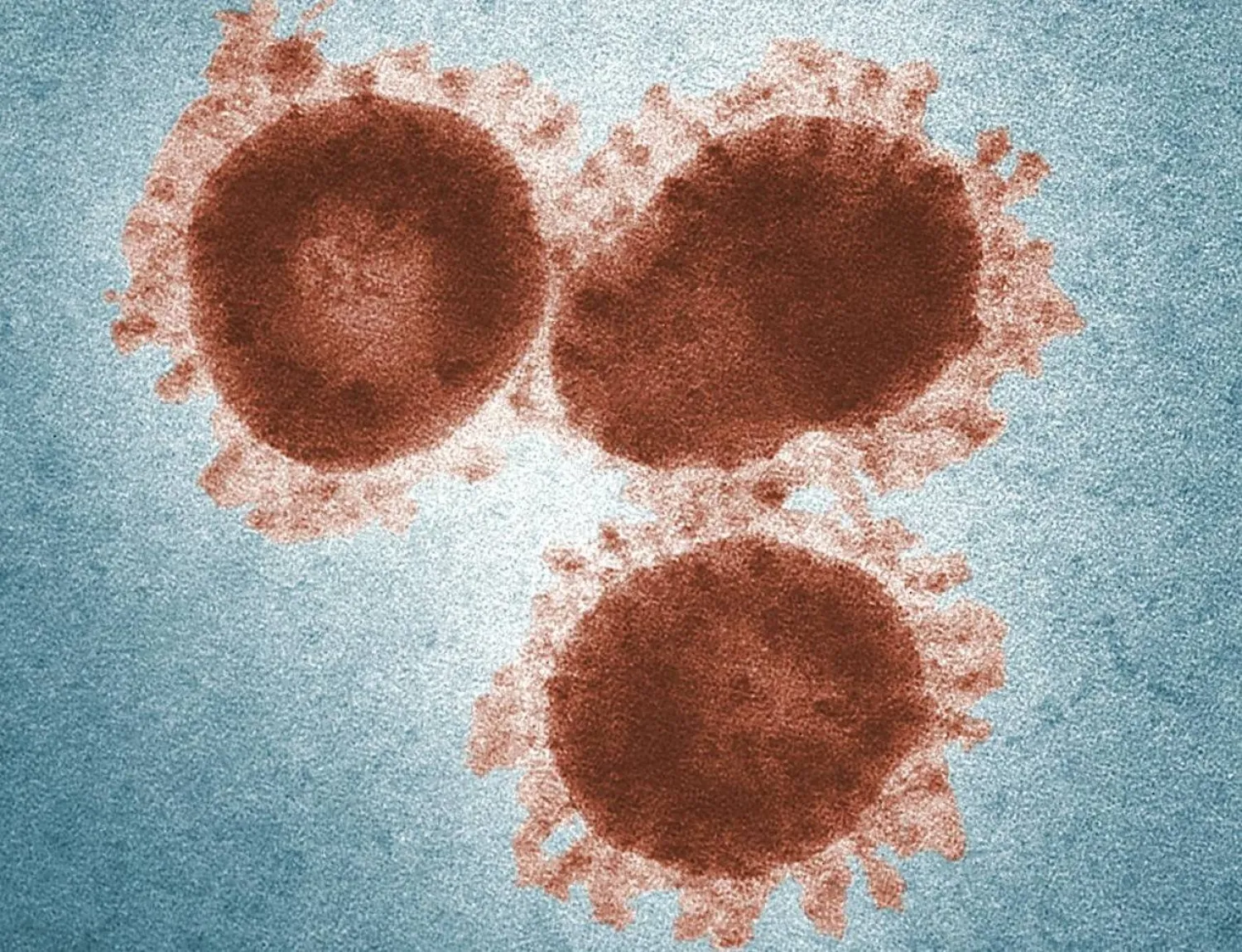 التهاب السحايا ينتج عن عدوى فيروسية أو بكتيرية (بيكسلز)