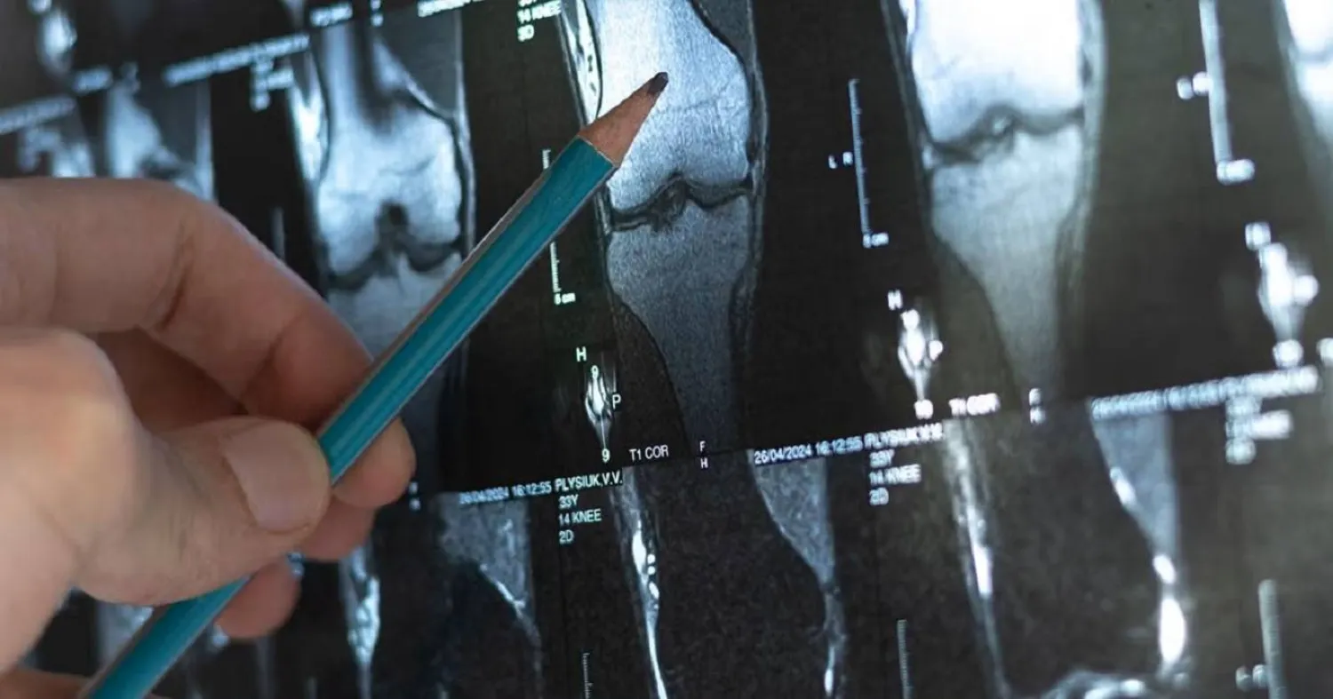 سرطان العظام يظهر عادة في الأطراف مثل عظام الساق (جامعة كيس ويسترن ريزيرف)