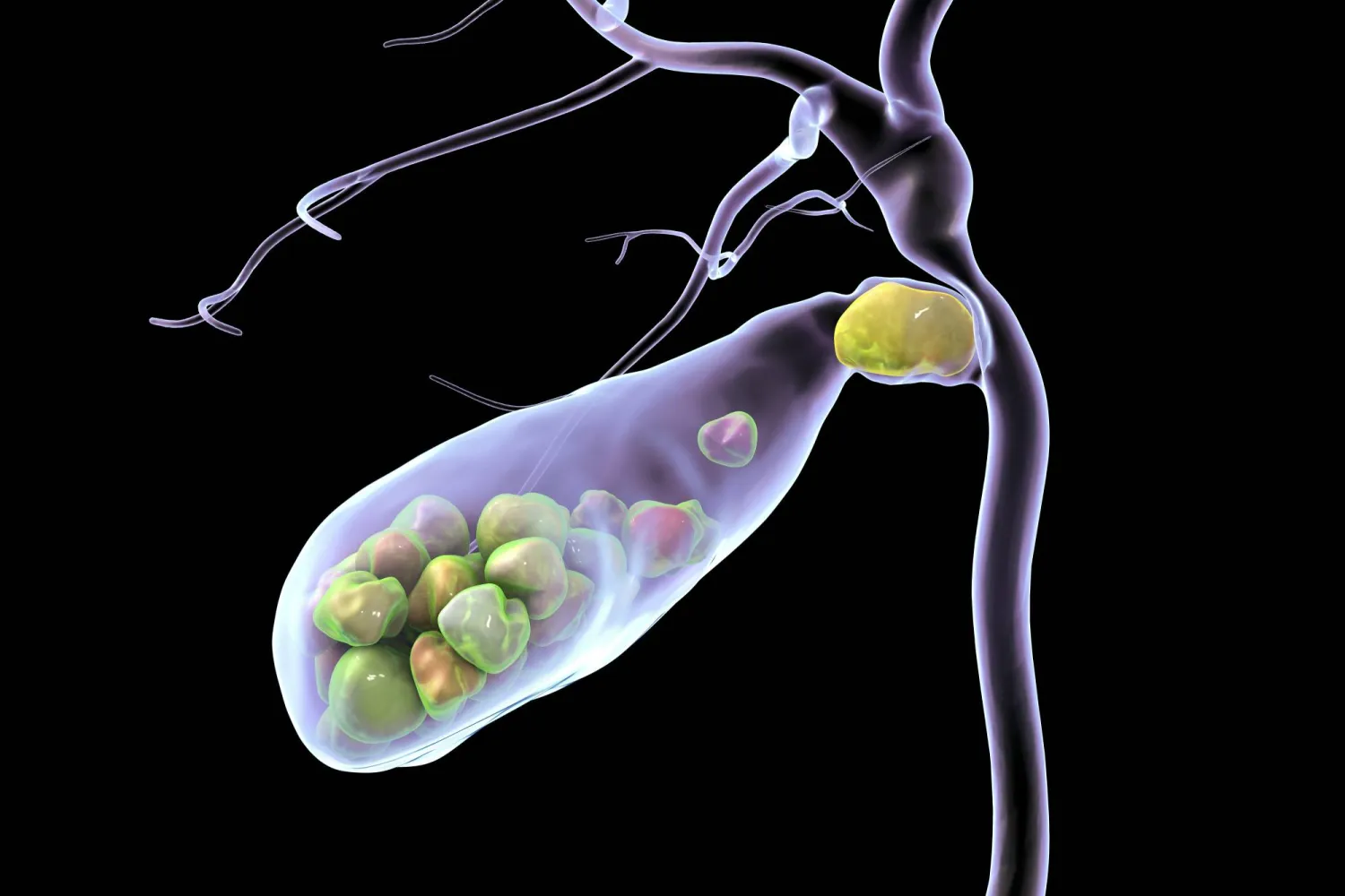 حصى المرارة... كيف تتكون وما طرق تشخيصها؟