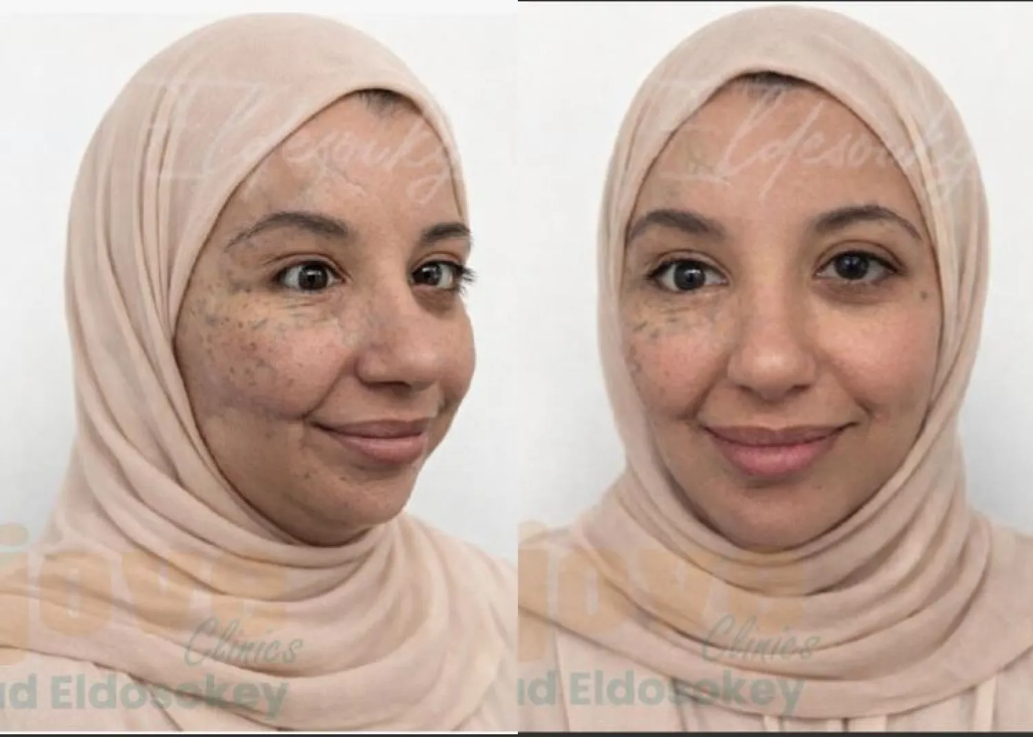 صورتان لآية سلامة بعد عمليات التجميل في مصر (الطبيب المعالج)