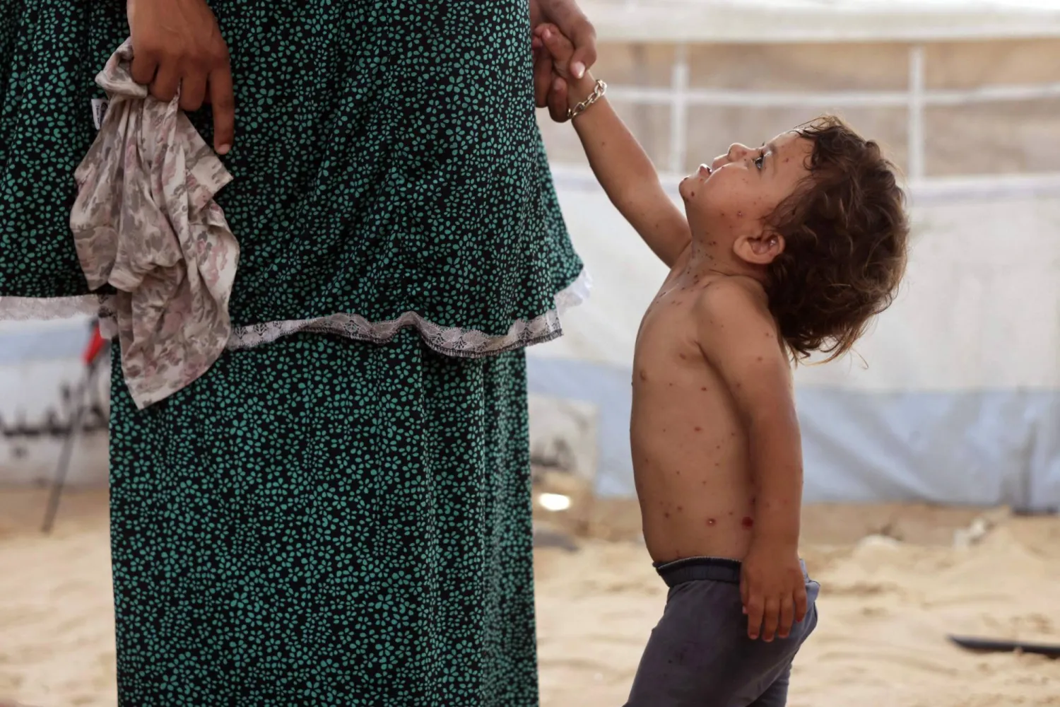 طفلة فلسطينية نازحة مصابة بجدري الماء تقف بجوار والدتها داخل خيمة في خان يونس جنوب غزة (أ.ف.ب)