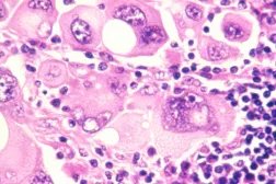 Amerika kıtasındaki araştırmacılar, melanom tümörlerini daha iyi tedavi etmelerini sağlayabilecek anahtar bir protein keşfetti (ABD Ulusal Kanser Enstitüsü)