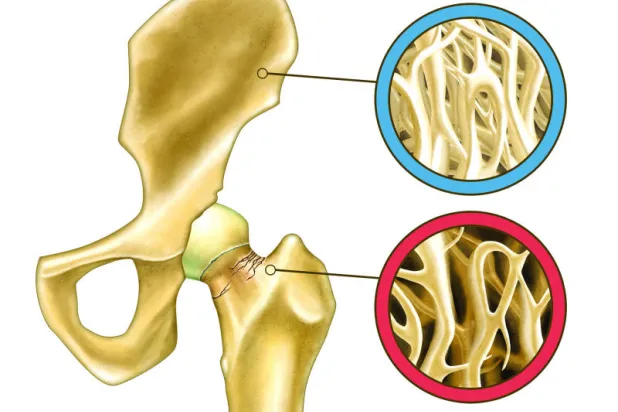 هشاشة العظام.. عوامل الإصابة ووسائل الوقاية