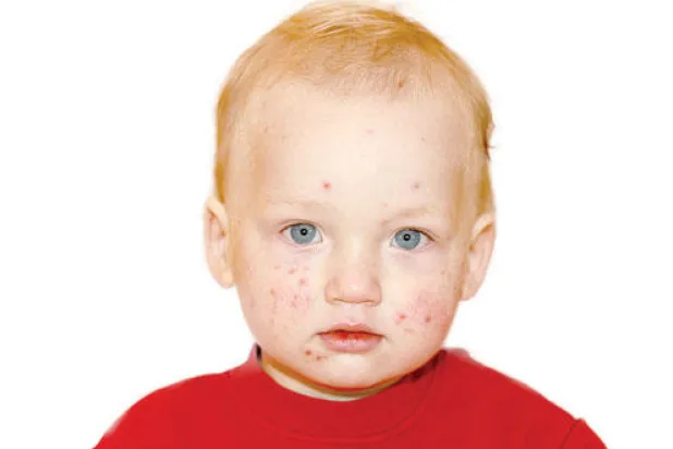 تفاقم عدوى الجديري المائي