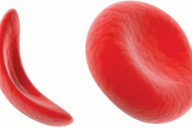 الخلايا الجذعية المشيمية بوابة الأمل لفقر الدم المنجلي والتلاسيميا