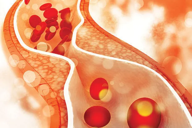 هل يمكن وقف عملية تصلب الشرايين وعكسها؟