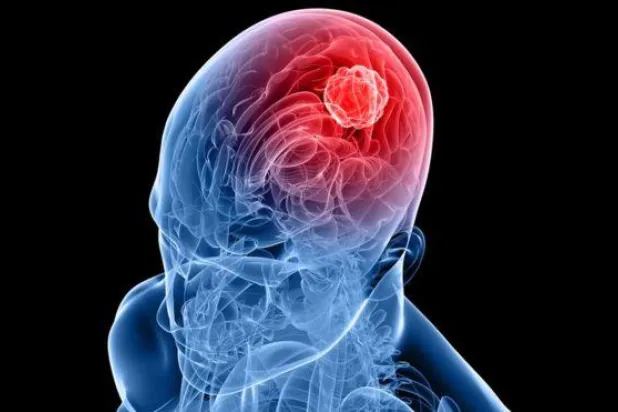 استخدام فيروس «زيكا» لعلاج سرطان الدماغ