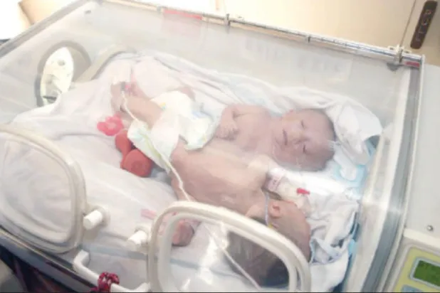 نقل التوأم السيامي الفلسطيني حنين وفرح من الأردن إلى المملكة