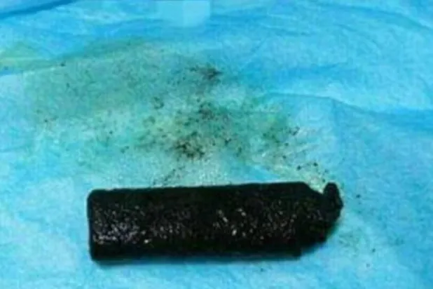 استخراج ولاعة سجائر من بطن صيني بعد 20 عاماً على ابتلاعها