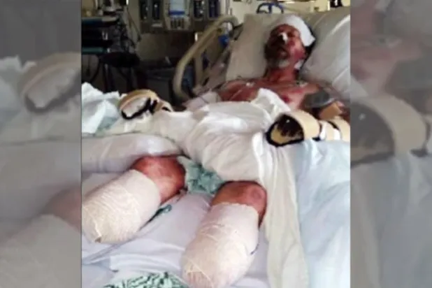 رجل يفقد جميع أطرافه نتيجة لعق كلبه له