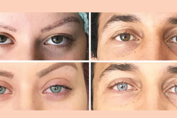 طبيب ألماني يغيّر بالليزر لون العين بشكل دائم