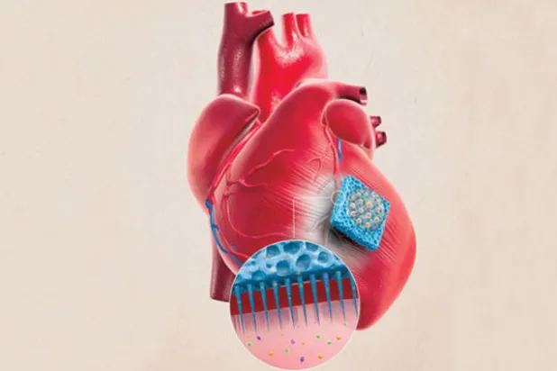 ضمادة مطورة لعلاج أضرار النوبات في القلب