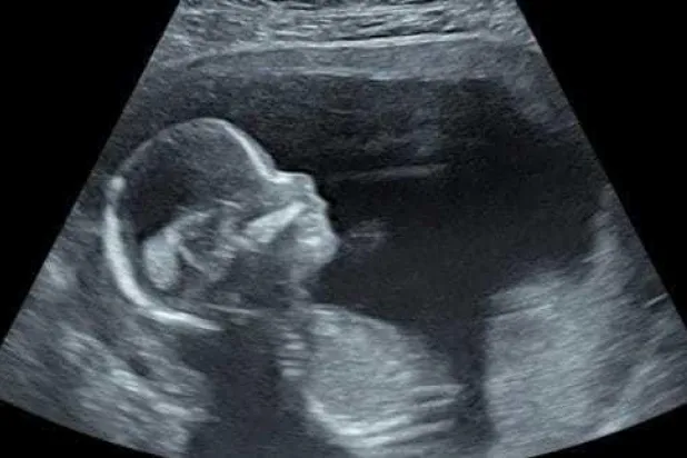 إخراج جنين من رحم أمه وإعادته بعد إجراء جراحة دقيقة له