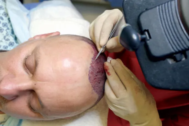 حلول جذرية مبتكرة لمشكلة الصلع