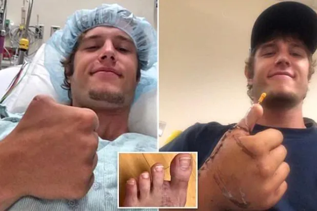 جراحون يستبدلون إبهام مقطوع لرجل أميركي بإصبع قدمه الكبير