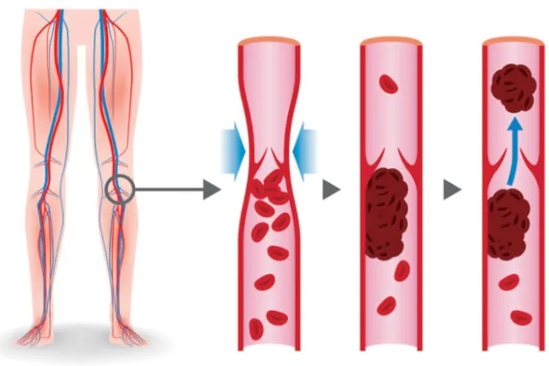 من الأرض... أطباء يعالجون رائد فضاء أميركياً أصيب بجلطة دموية