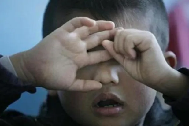 علاج «السوائل الزائدة» في الجسم يخفف من أعراض التوحد