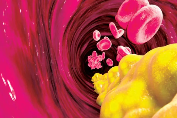 ما الفرق بين الكوليسترول والدهون الثلاثية؟