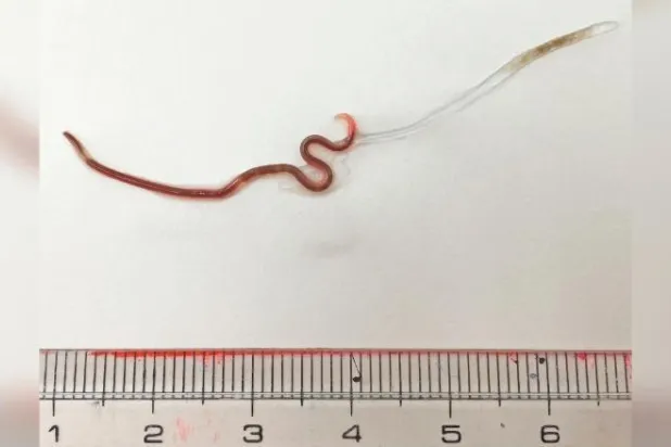 أطباء يزيلون دودة حية من لوزة امرأة في اليابان