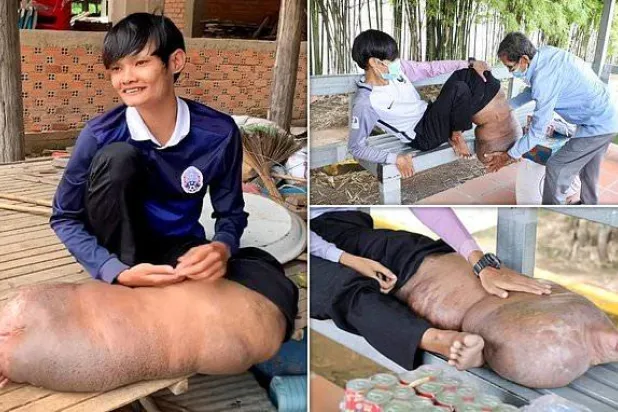 بسبب لدغات بعوض... ساق شاب تنتفخ أكثر من حجمها الطبيعي بـ5 مرات