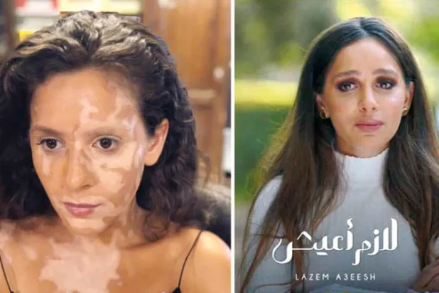 مسلسل مصري يسلّط الضوء على معاناة مرضى البهاق