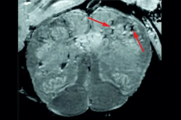 Koronavirüs beyin hasarına da sebep oluyor  