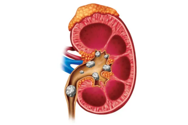 كيف تتجنب نوبات حصوات الكلى؟