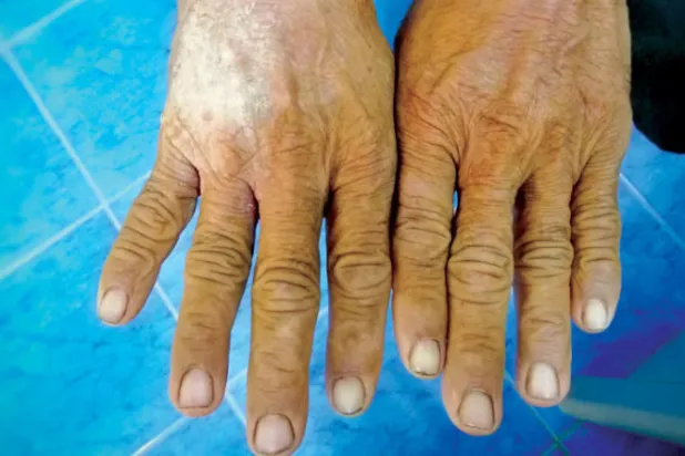 «تصلب الجلد المناعي» مرض يغير الحياة ويهدد بالوفاة