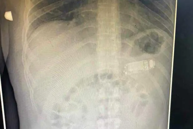 شاهد... استخراج هاتف جوال من معدة سجين في كوسوفو