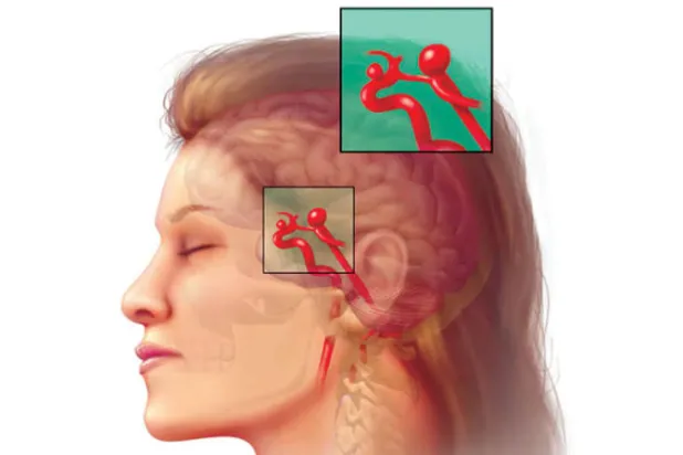 أداة للكشف المبكر عن {القاتل الصامت} في الدماغ