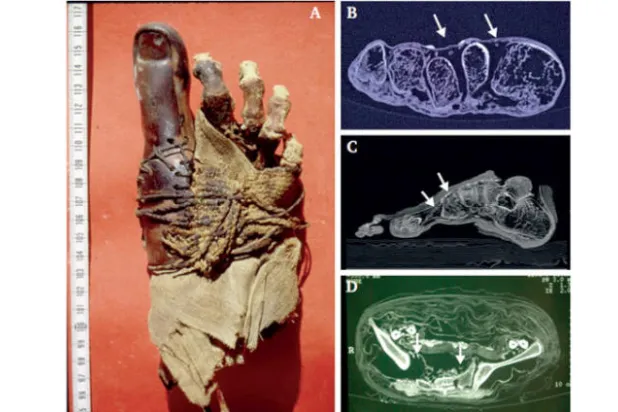 اكتشاف أول دليل على «تصلّب الشرايين المحيطي» في مومياء مصرية