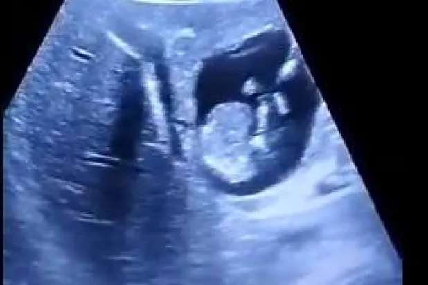 في حالة نادرة جداً... جنين ينمو داخل كبد والدته