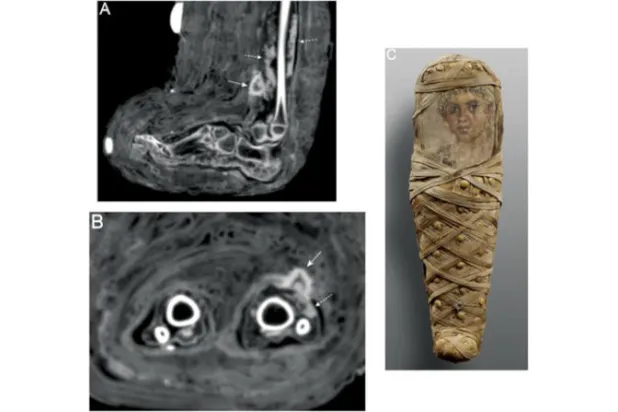 اكتشاف أول ضمادة في مصر القديمة