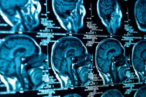 تقرير: تزايد الإصابات بمرض عصبي محيّر في مقاطعة كندية