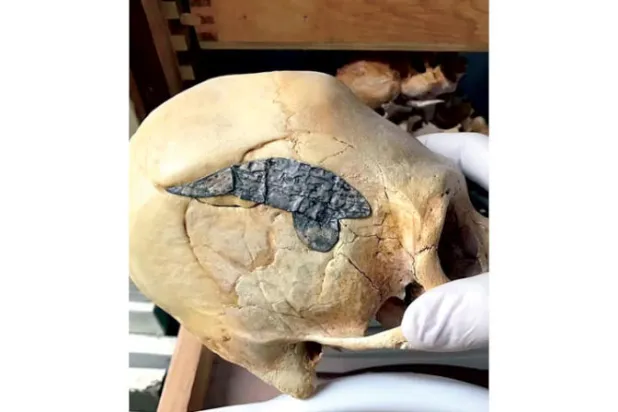 أول جراحة في العالم على رأس محارب بيروفي قبل 2000 عام